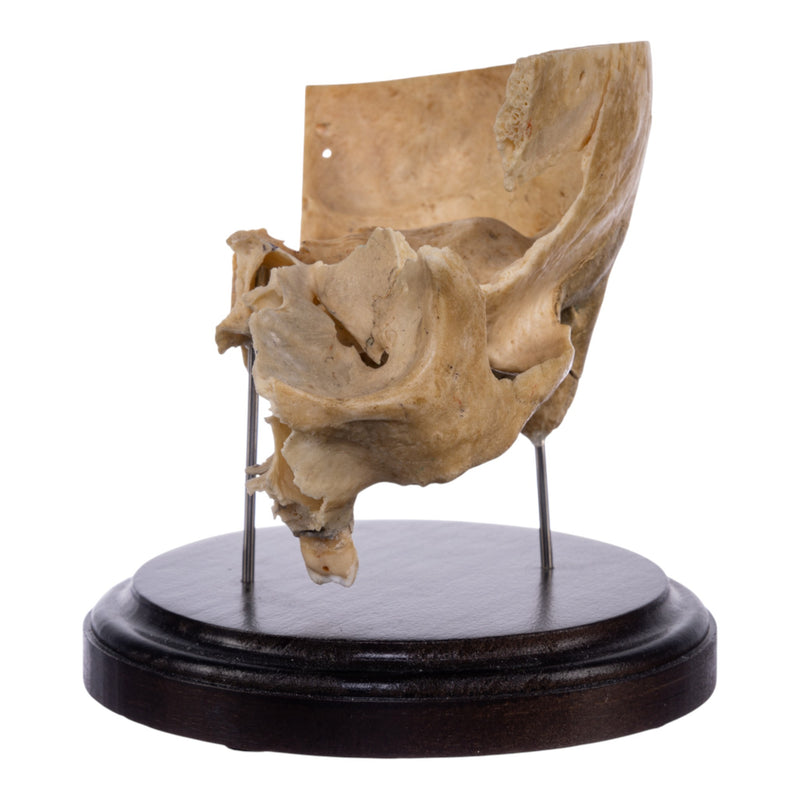 Real Human Partial Skull on Stand