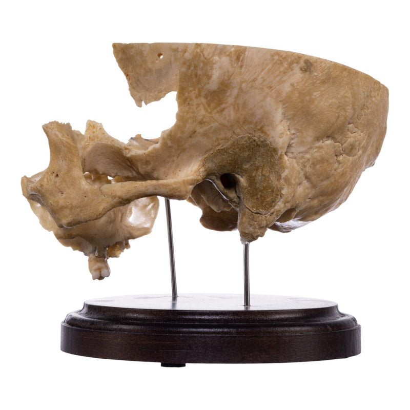 Real Human Partial Skull on Stand