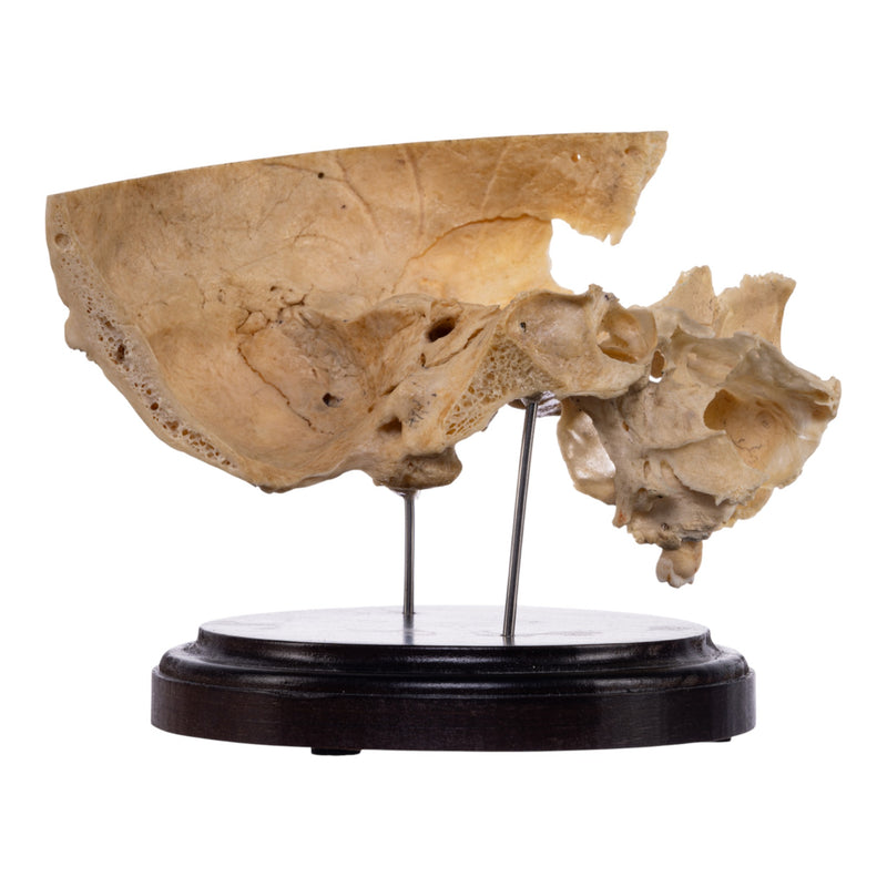 Real Human Partial Skull on Stand