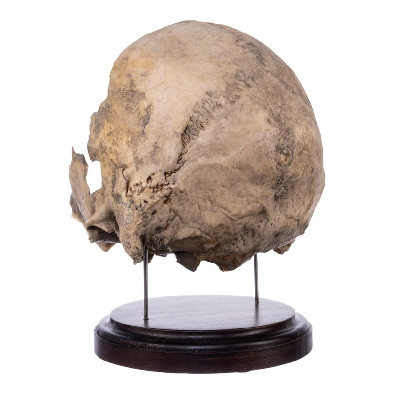 Real Human Partial Skull on Stand