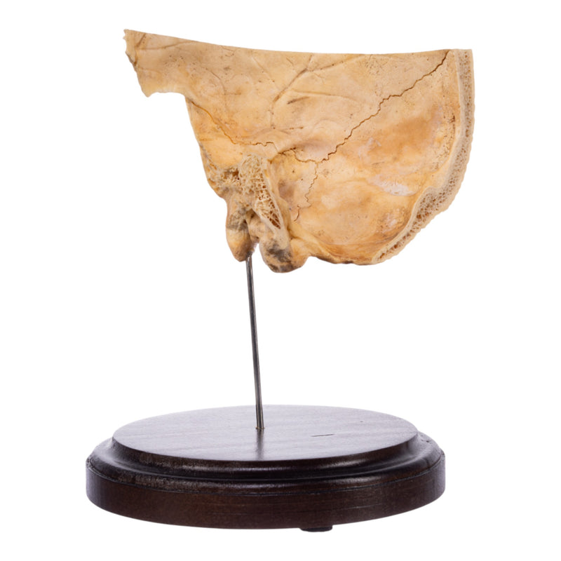 Real Human Partial Skull on Stand