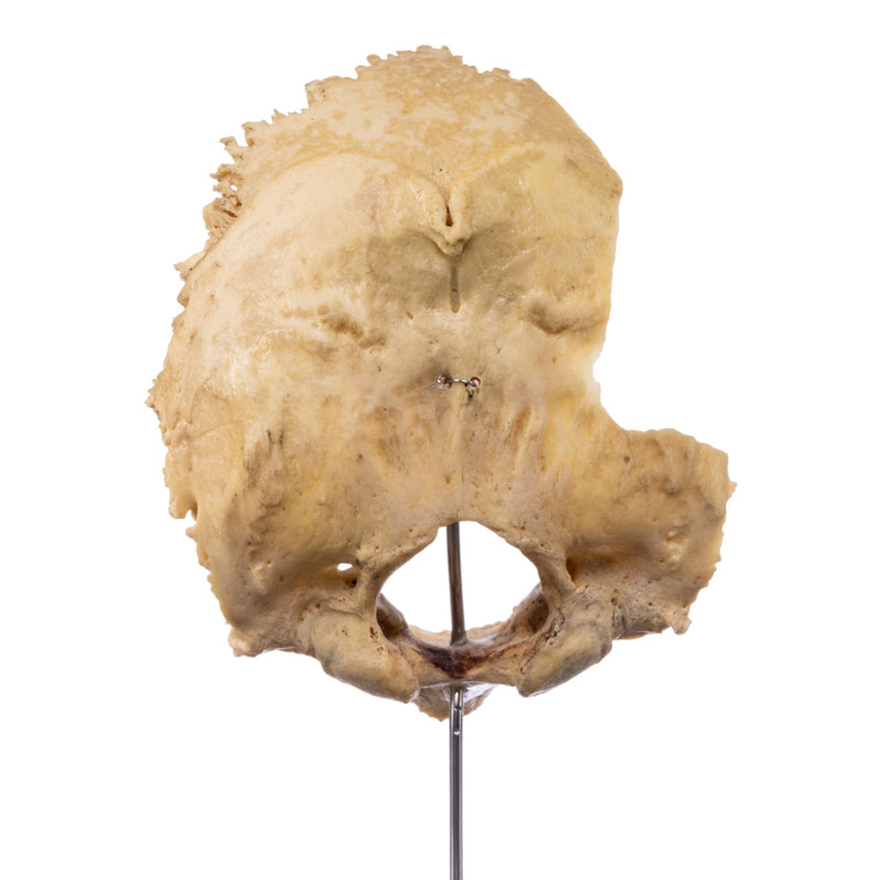 Real Human Partial Skull on Stand