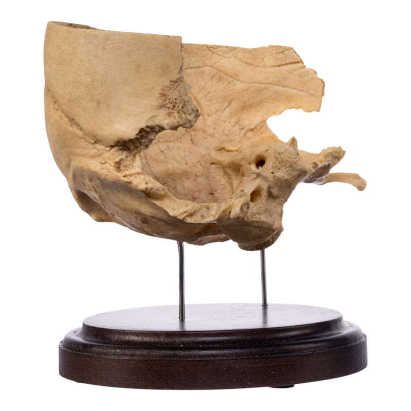Real Human Partial Skull on Stand