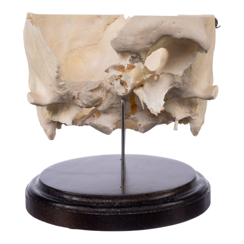 Real Human Partial Skull on Stand