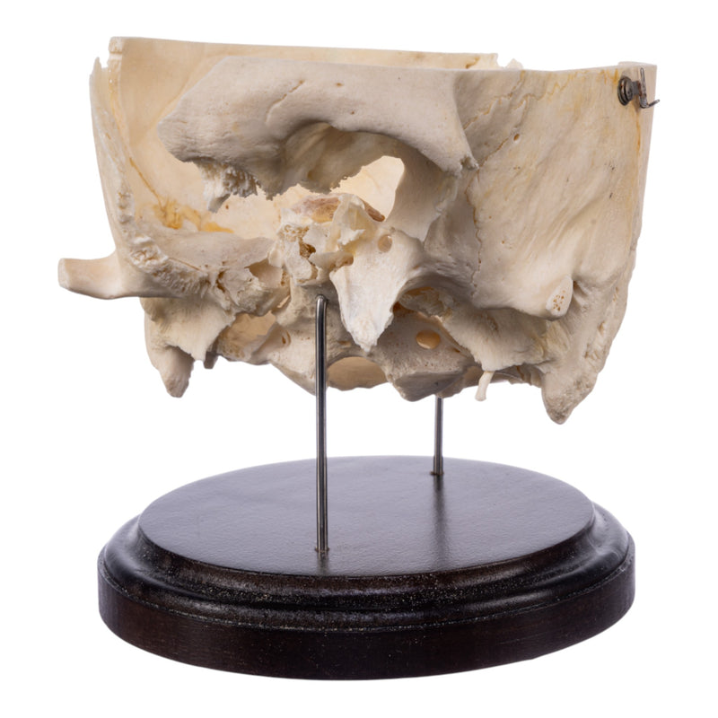 Real Human Partial Skull on Stand