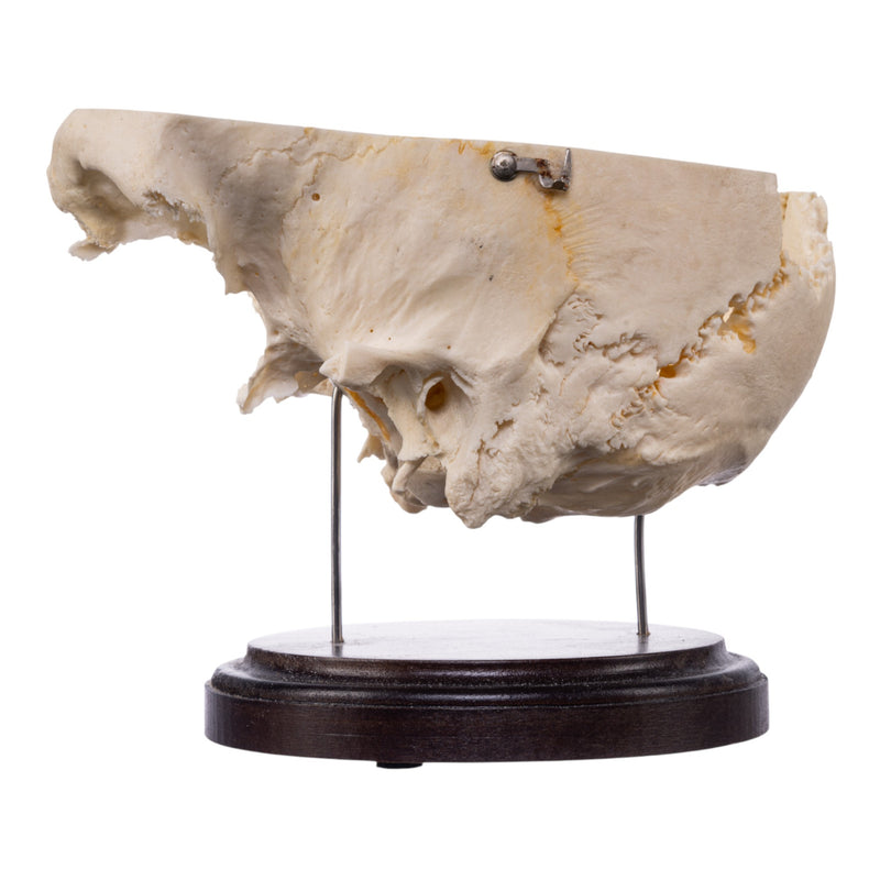 Real Human Partial Skull on Stand