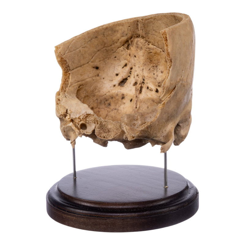 Real Human Partial Skull on Stand