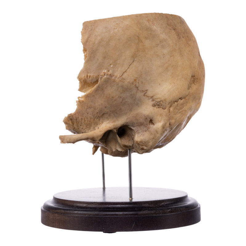 Real Human Partial Skull on Stand