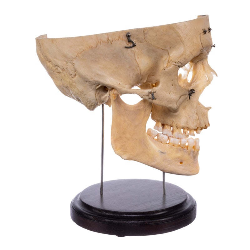 Real Human Partial Skull - Dissected