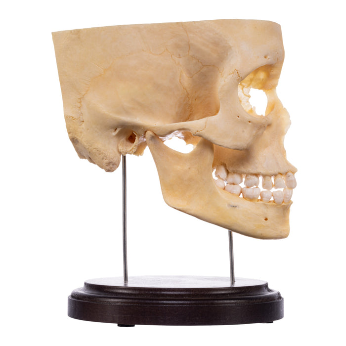 Real Human Partial Skull on Stand