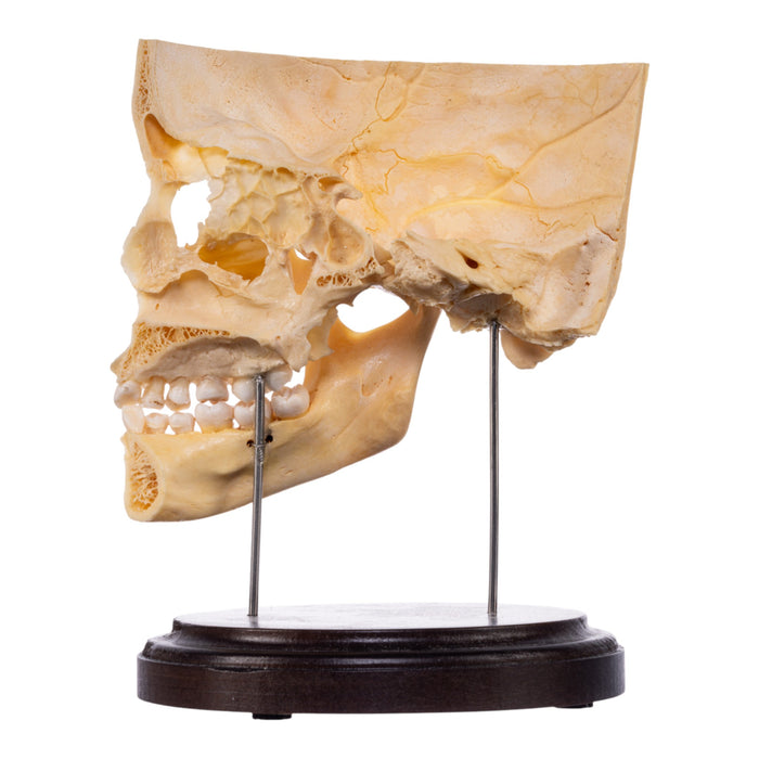 Real Human Partial Skull on Stand