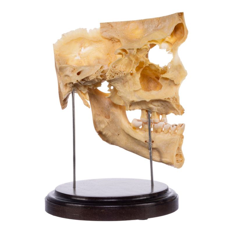 Real Human Partial Skull on Stand