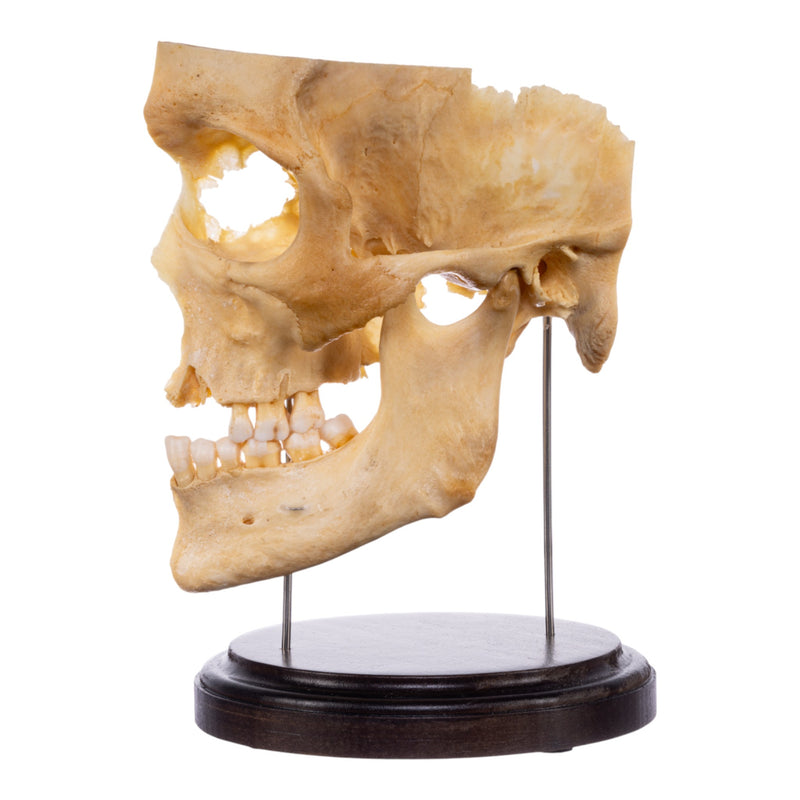 Real Human Partial Skull on Stand