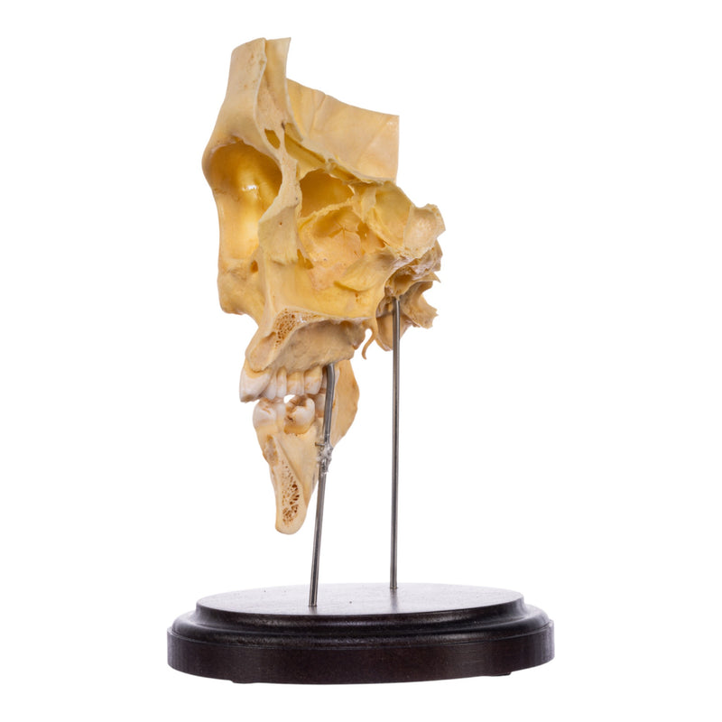 Real Human Partial Skull on Stand