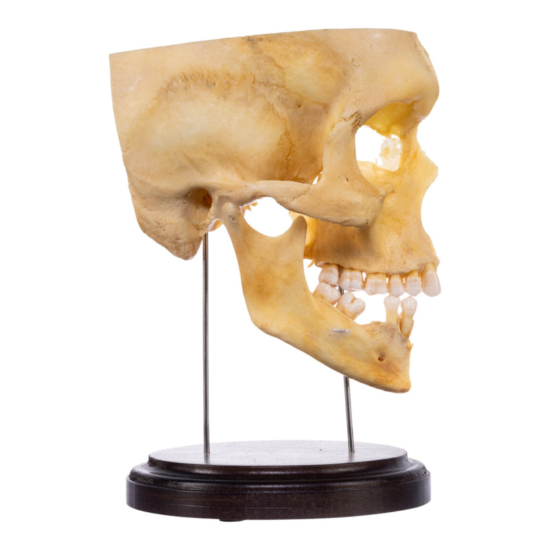 Real Human Partial Skull on Stand