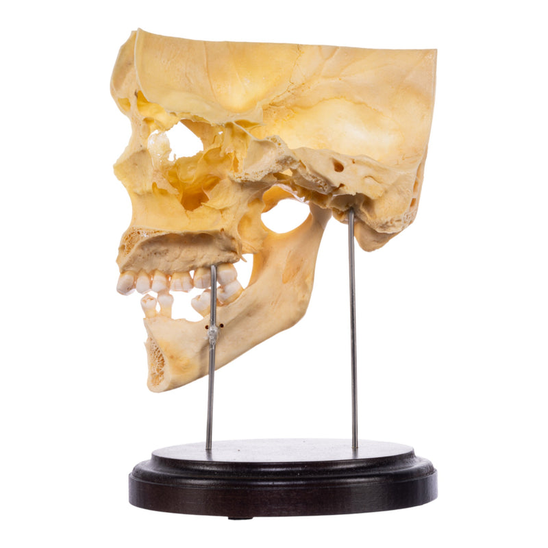 Real Human Partial Skull on Stand