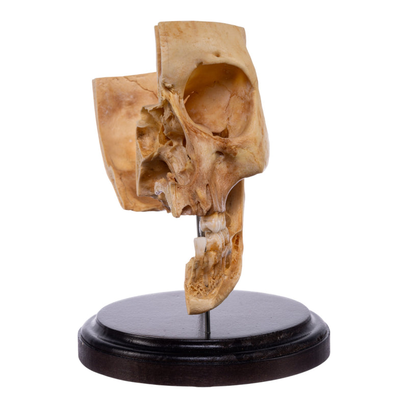 Real Human Partial Skull on Stand