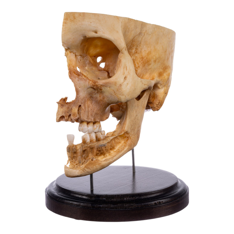 Real Human Partial Skull on Stand