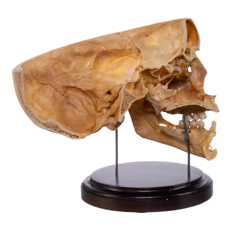 Real Human Partial Skull on Stand