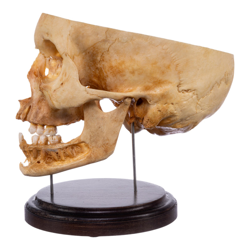 Real Human Partial Skull on Stand