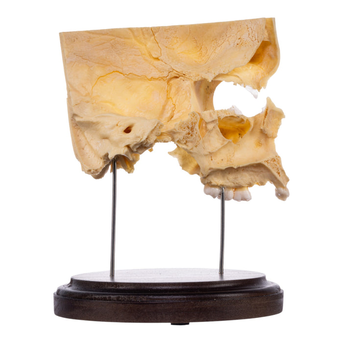 Real Human Partial Skull on Stand