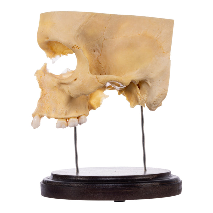 Real Human Partial Skull on Stand