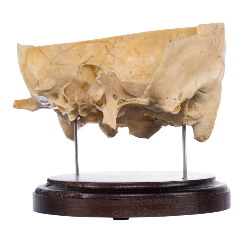 Real Human Partial Skull on Stand