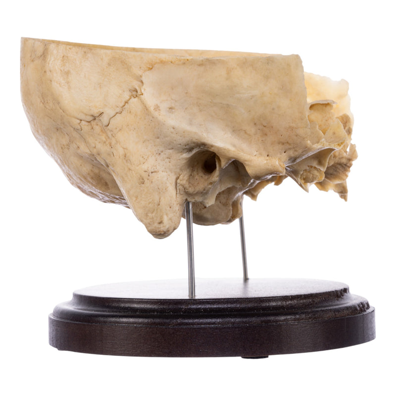 Real Human Partial Skull on Stand