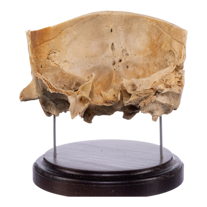 Real Human Partial Skull on Stand