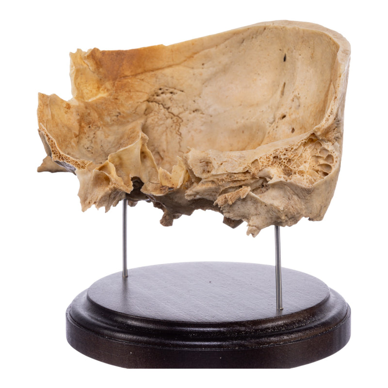 Real Human Partial Skull on Stand
