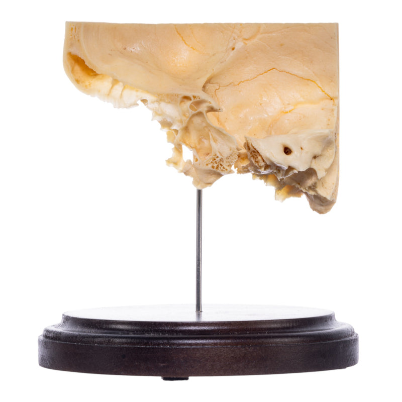 Real Human Partial Skull on Stand