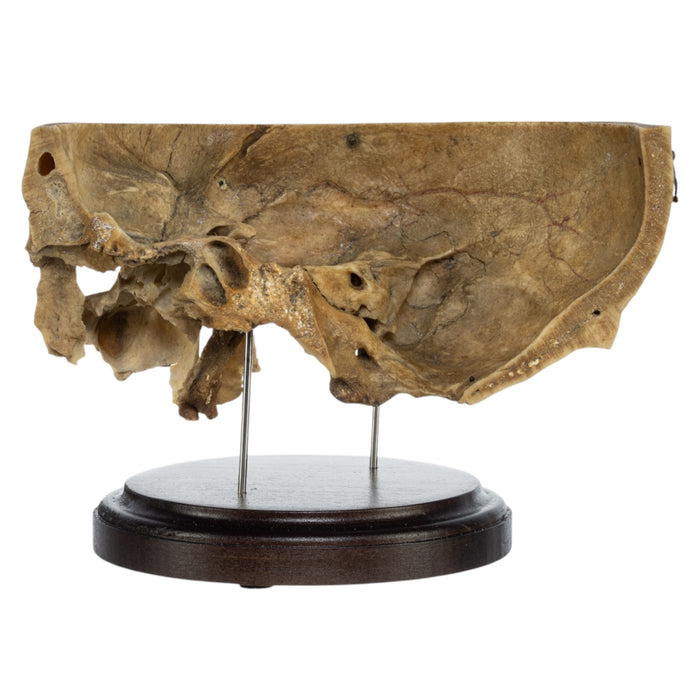 Real Human Partial Skull on Stand