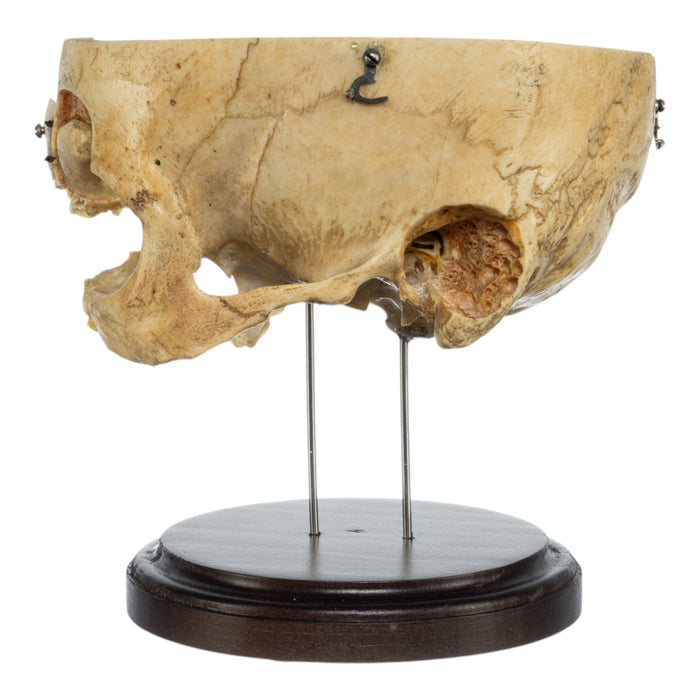 Real Human Partial Skull on Stand