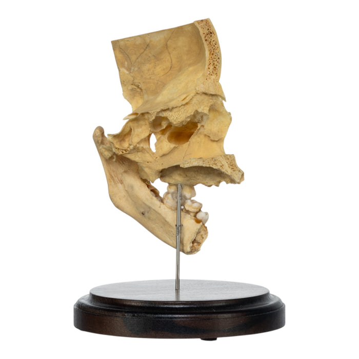Real Human Partial Skull on Stand