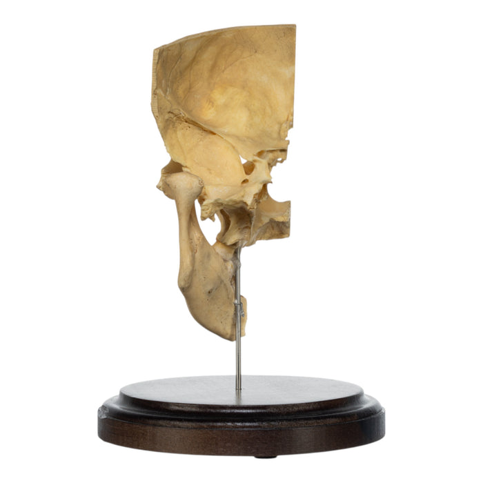 Real Human Partial Skull on Stand