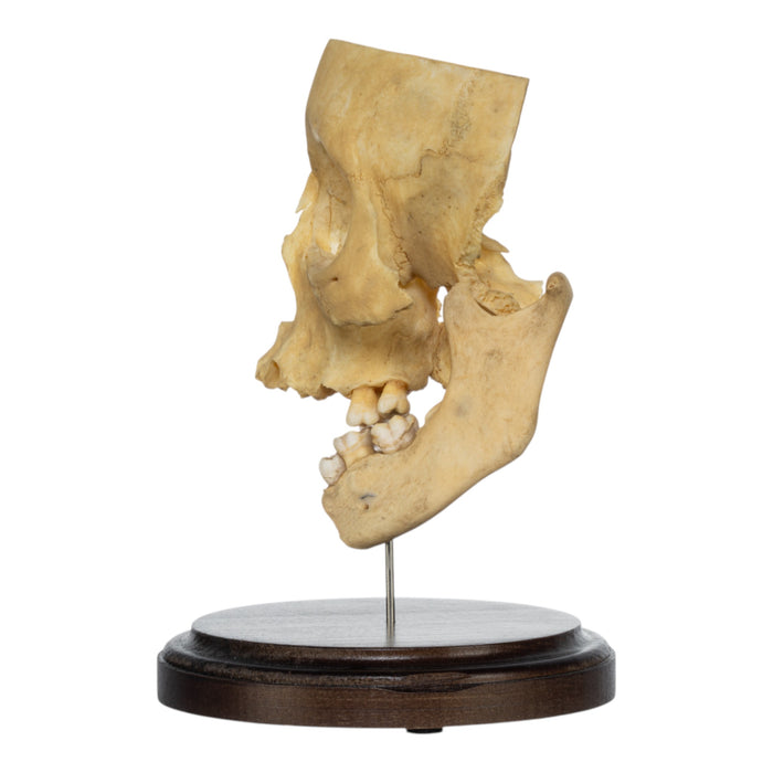 Real Human Partial Skull on Stand