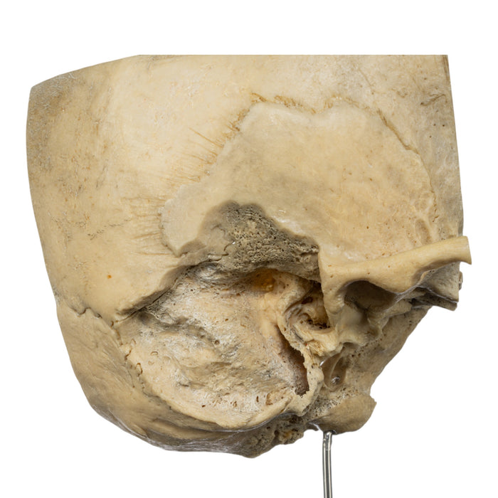 Real Human Partial Skull on Stand
