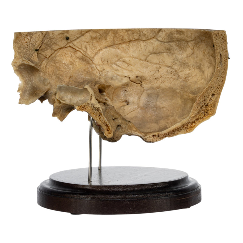 Real Human Partial Skull on Stand