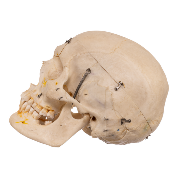 Real Human Skull with Carrying Case - Dissected