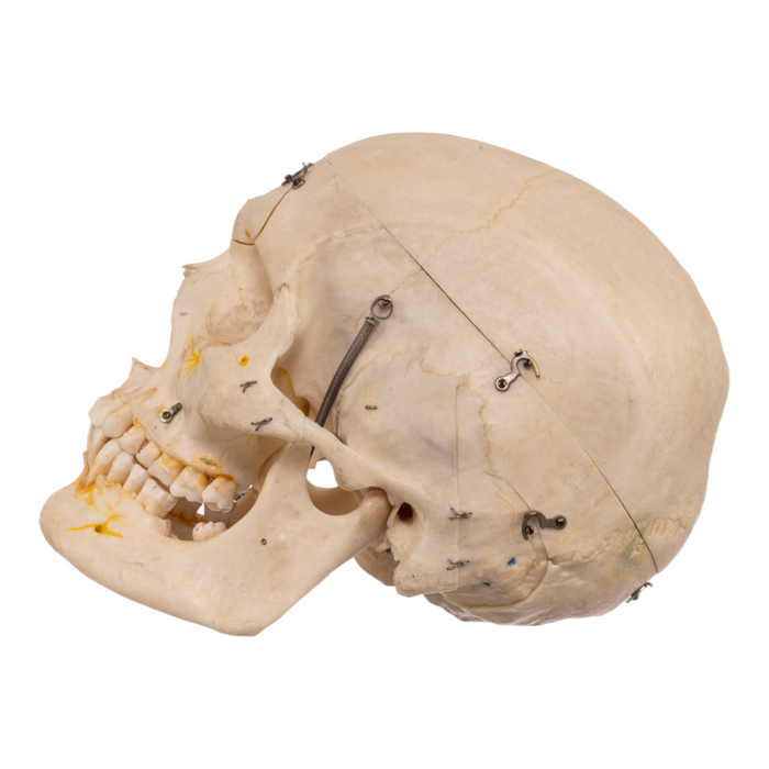 Real Human Skull with Carrying Case  - Dissected