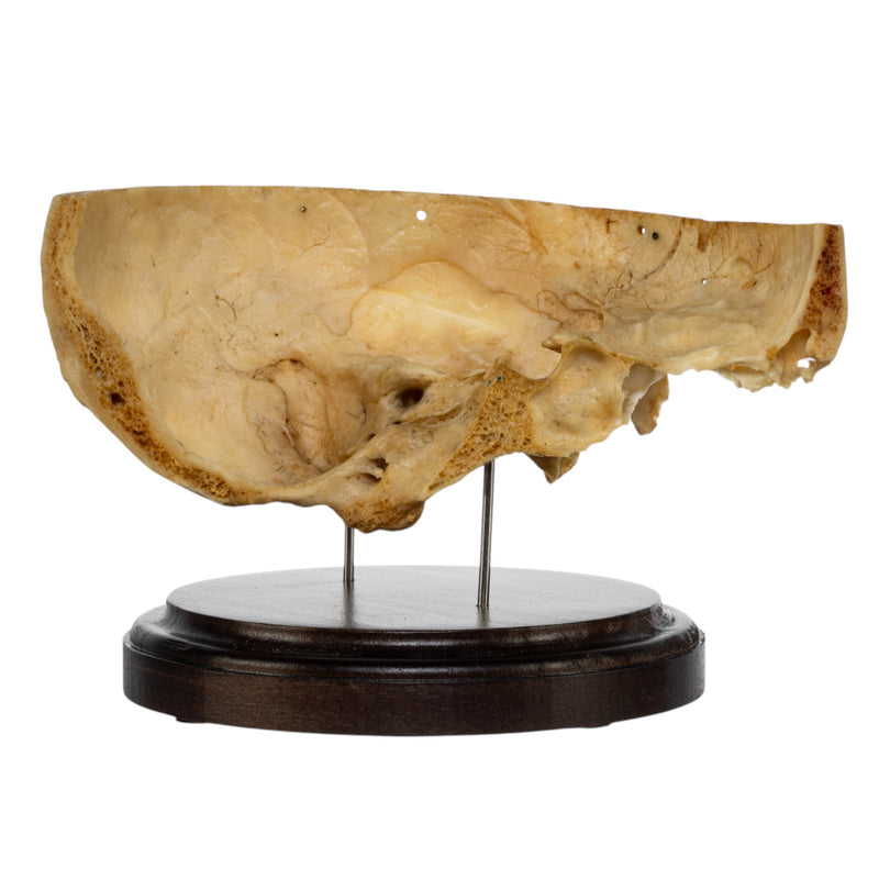 Real Human Partial Skull on Stand