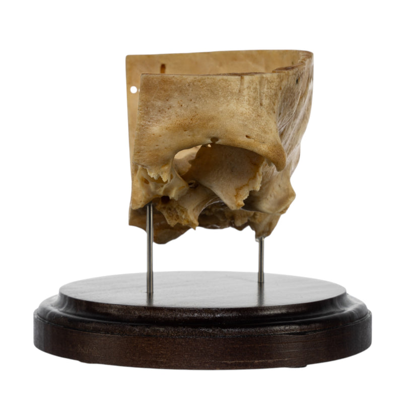 Real Human Partial Skull on Stand