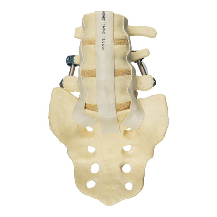Replica Human Sacrum & Lumbar Model with Hardware