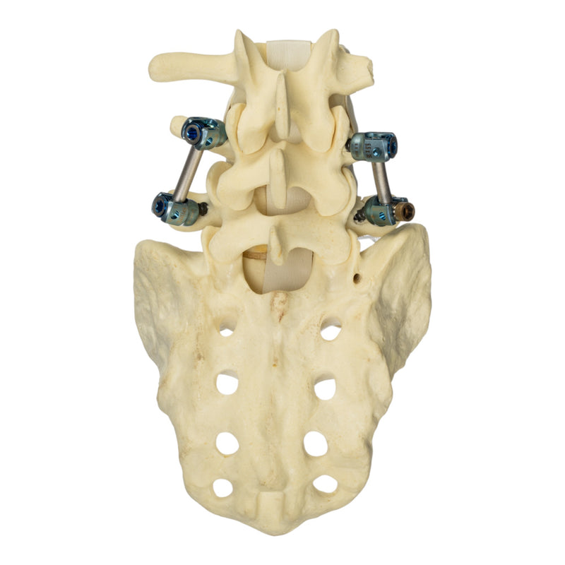 Replica Human Sacrum & Lumbar Model with Hardware