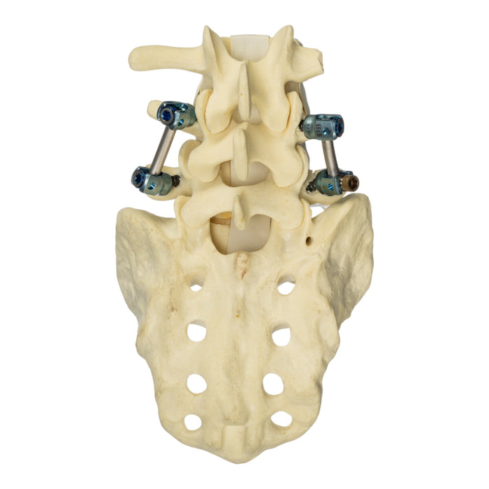 Replica Human Sacrum & Lumbar Model with Hardware