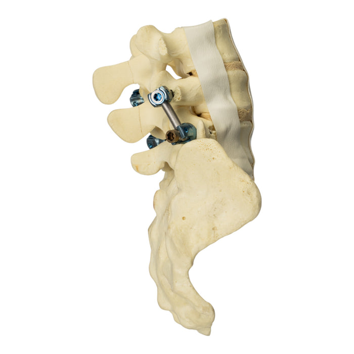 Replica Human Sacrum & Lumbar Model with Hardware