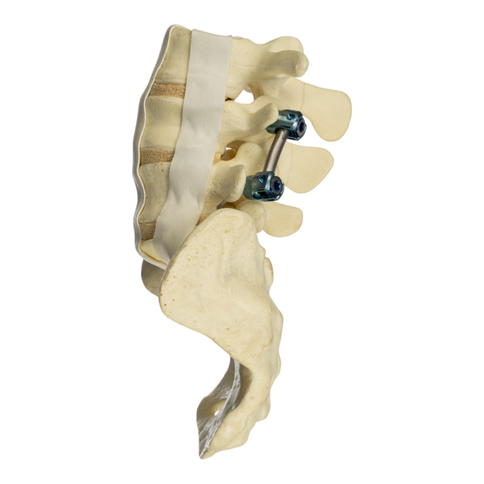 Replica Human Sacrum & Lumbar Model with Hardware