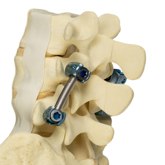 Replica Human Sacrum & Lumbar Model with Hardware