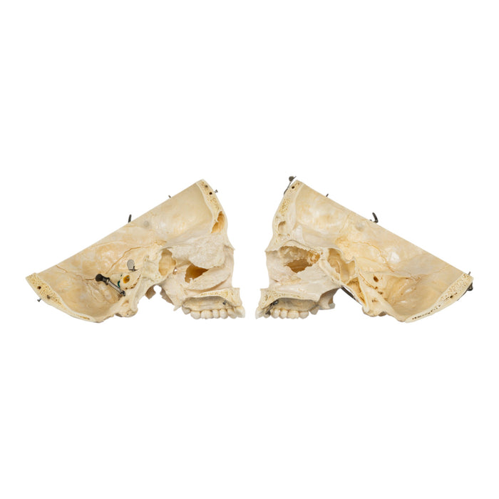 Real Human Skull - Dissected
