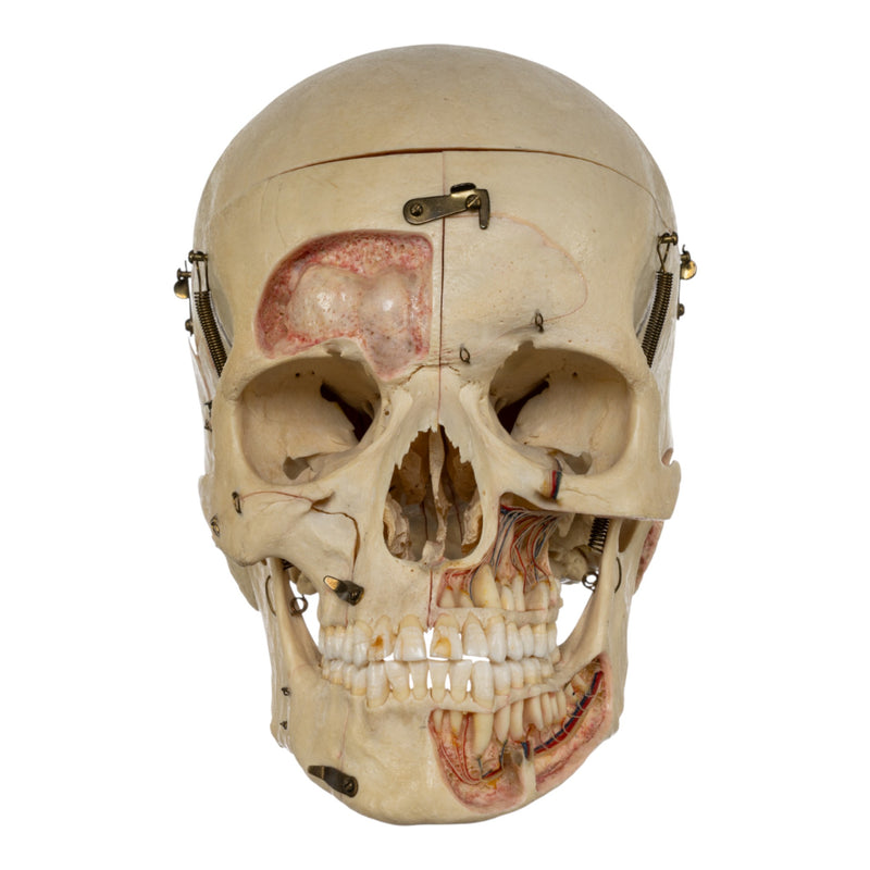 Real Human Dissected Skull in Carrying Case